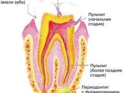 Лечение пульпита зуба