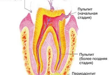 Лечение глубокого кариеса