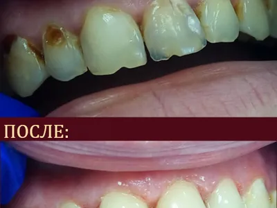 реставрация зубов