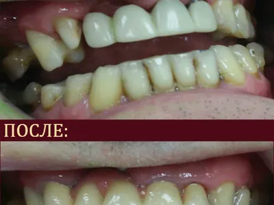 протезирование зубов