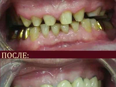 протезирование зубов