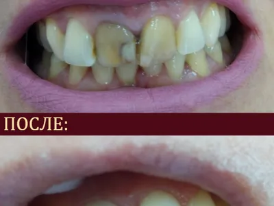 реставрация зубов