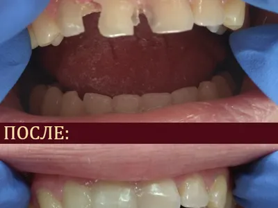 реставрация зубов