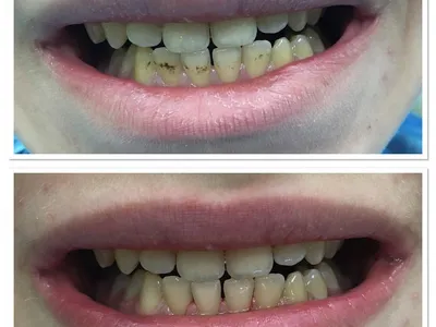 гигиеническая чистка