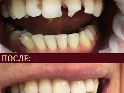 гигиеническая чистка