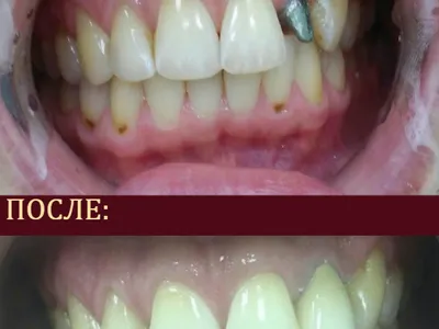 протезирование зубов