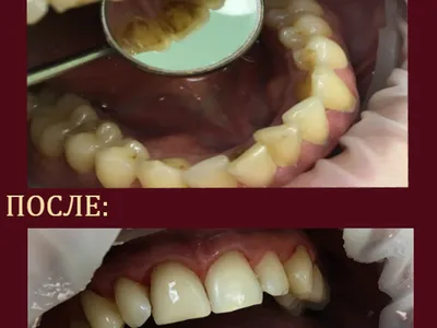 гигиеническая чистка