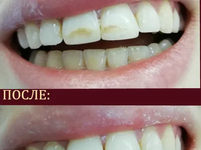 реставрация зубов