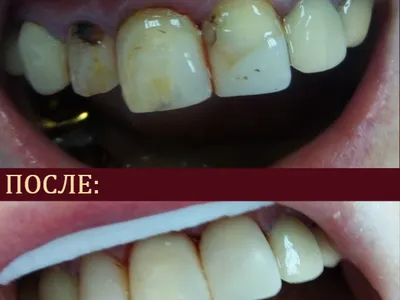 реставрация зубов