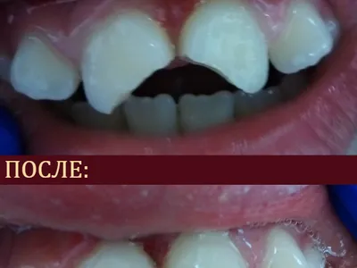 реставрация зубов