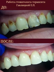 реставрация зубов