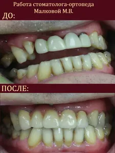 протезирование зубов