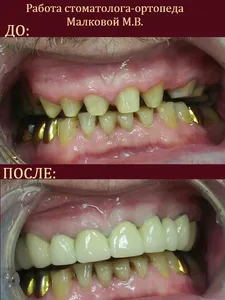 протезирование зубов