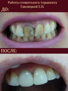 реставрация зубов