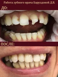 гигиеническая чистка