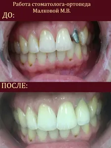 протезирование зубов