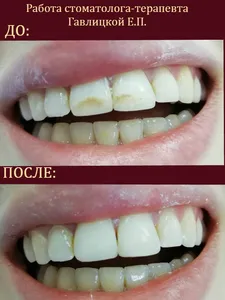 реставрация зубов