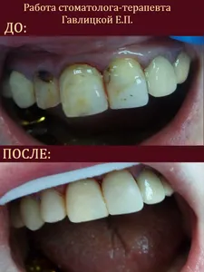 реставрация зубов