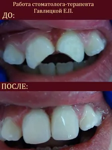 реставрация зубов